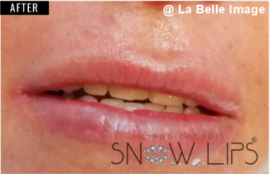 リップホワイトニングセッションセッション後3